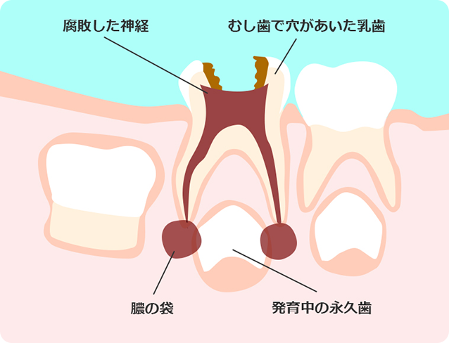 乳歯のむし歯は永久歯に影響を与える