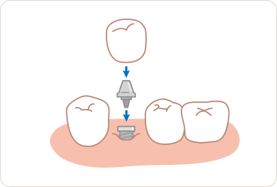 インプラント／平均寿命10年以上または半永久的