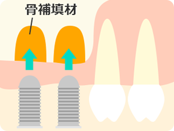 ソケットリフト