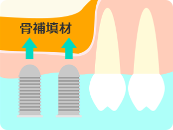 サイナスリフト