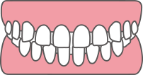 すきっ歯 空隙歯列（くうげきしれつ）
